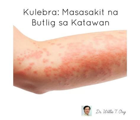 kulibrang tubig|Kulebra: Masasakit na butlig sa katawan .